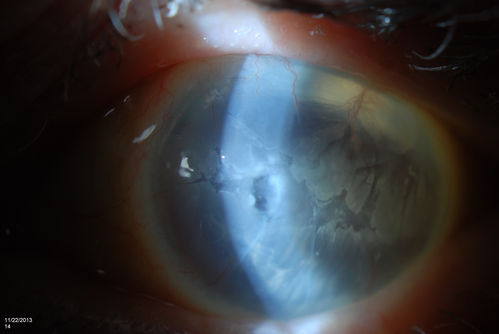 Band Keratopathy/Neurotrophic Ulcer
Patient comes in with blind painful left eye. Slit lamp photos shows corneal diffuse scarring, descemets folds, corneal striae, band keratopathy, left eye. Proceed with Jupiter contact lens fitting on the left eye. 
