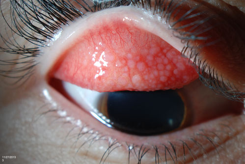 Giant Papillary Conjunctivitis
Patient wears soft contact lenses complained of irritation when the SCL would move. Inverted eyelid in both eyes and there was papillary +2 underneath the eyelid. 
Mots-clés: december2013