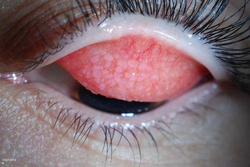 Giant Papillary Conjunctivitis
Patient wears soft contact lenses complained of irritation when the SCL would move. Inverted eyelid in both eyes and there was papillary +2 underneath the eyelid. 
