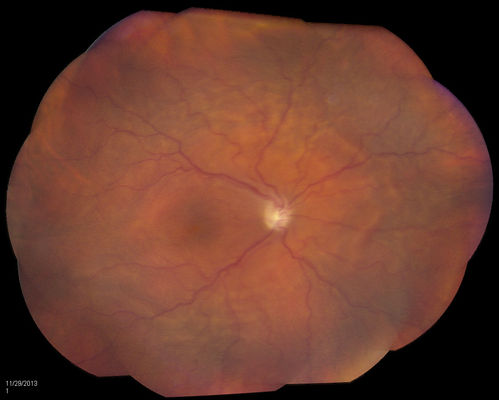 Thick Choroid Probably from Hypotony
Patient comes in with blurred vision in the right eye. VA is CF. with pinhole at 20/400. Fundus photography shows moderate thickening of the choroid. IOP was 5 in the right eye.
Keywords: november2013