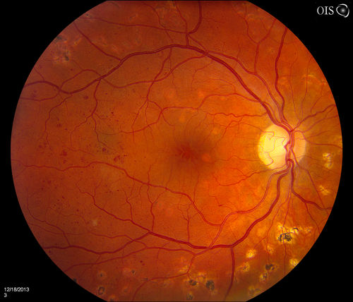 Diabetic Retinopathy with CME
Second opinion for diabetic retinopathy. VA is 20/30, right eye, 20/50, left eye. Patient has mild swelling in the macula of the right eye. No evidence of CME but does have a moderate cataract in the left eye. 
