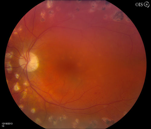 Diabetic Retinopathy with CME
Second opinion for diabetic retinopathy. VA is 20/30, right eye, 20/50, left eye. Patient has mild swelling in the macula of the right eye. No evidence of CME but does have a moderate cataract in the left eye. 

