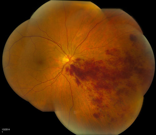 Branch Retinal Vein Occlusion
Patient's VA was 20/40, right eye. Fundus exam shows branch retinal vein occlusion nasally to the optic nerve in the right eye. 
