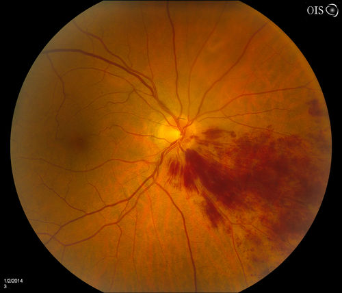 Branch Retinal Vein Occlusion
Patient's VA was 20/40, right eye. Fundus exam shows branch retinal vein occlusion nasally to the optic nerve in the right eye. 

