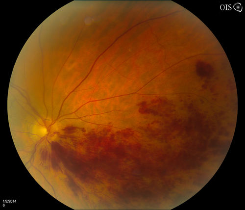 Branch Retinal Vein Occlusion
Patient's VA was 20/40, right eye. Fundus exam shows branch retinal vein occlusion nasally to the optic nerve in the right eye. 
