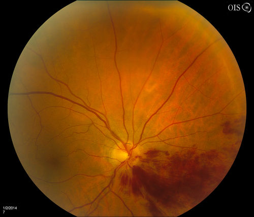 Branch Retinal Vein Occlusion
Patient's VA was 20/40, right eye. Fundus exam shows branch retinal vein occlusion nasally to the optic nerve in the right eye. 
