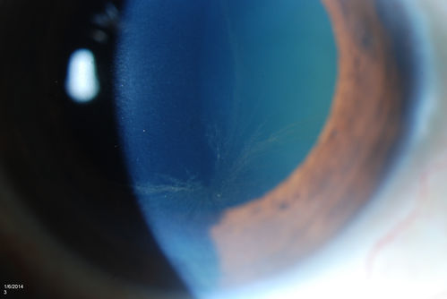 Vortex Kerotopathy
Patient that is on the medication Amiodarone, developed vortex kerotopathy on the inferior part of the cornea in both eyes.
