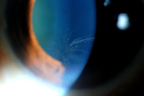 Patient that is on the medication Amiodarone, developed vortex kerotopathy on the inferior part of the cornea in both eyes.
