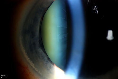 Pseudoexfoliation with Cortical Cataract Changes
Patient comes in for eval on cataract surgery for the right eye. Slit lamp exam shows pseudoexfoliation (XFS) scattered on the lens in the right eye. Patient will be followed for glaucoma suspect and to schedule cataract surgery in the future... 

