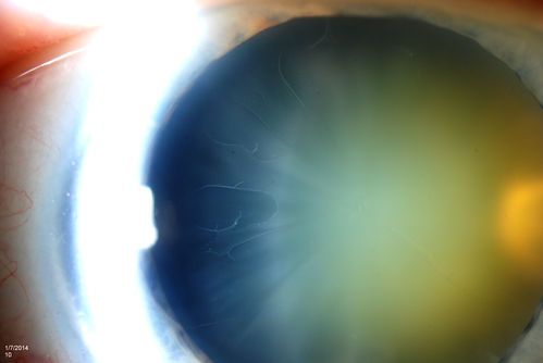 Pseudoexfoliation with Cortical Cataract Changes
Patient comes in for eval on cataract surgery for the right eye. Slit lamp exam shows pseudoexfoliation (XFS) scattered on the lens in the right eye. Patient will be followed for glaucoma suspect and to schedule cataract surgery in the future... 
