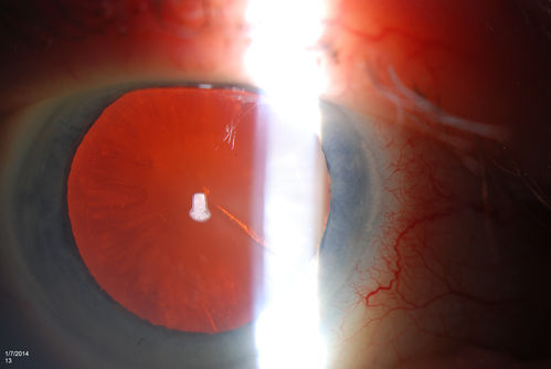 Pseudoexfoliation with Cortical Cataract Changes
Patient comes in for eval on cataract surgery for the right eye. Slit lamp exam shows pseudoexfoliation (XFS) scattered on the lens in the right eye. Patient will be followed for glaucoma suspect and to schedule cataract surgery in the future... 
