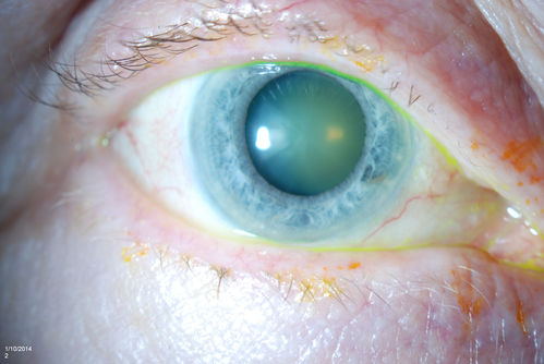 Glaucoma, Pseudoexfoliation Ring
Slit Lamp photography shows prominent pseudoexfoliation ring on the lens of the left eye. Patient will be followed up in 6-months...
