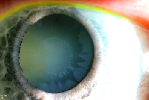 Glaucoma, Pseudoexfoliation Ring
Slit Lamp photography shows prominent pseudoexfoliation ring on the lens of the left eye. Patient will be followed up in 6-months...
