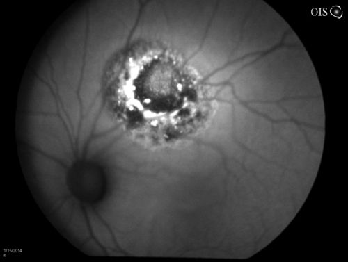 Choroidal Melanoma with Sub Retinal Fluid
Fundus photography shows choroidal melanoma superiorily between 11-12-o'clock in the left eye. VA is 20/150 in the left eye. 
