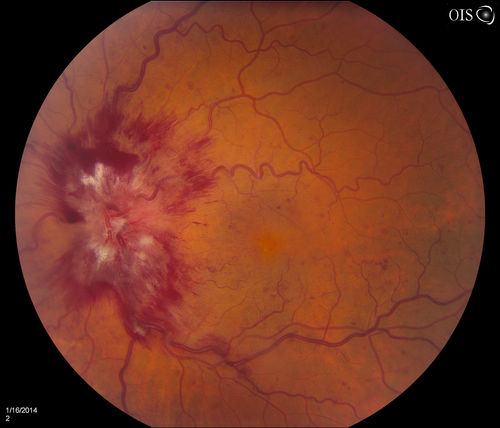 Central Retinal Vein Occlusion with Macular Edema
Patient notices decreased vision in the left eye. VA is 20/60, left eye. Fundus and Fluorescence Angiogram shows CRVO in the left eye with scattered hemorrhages throughout the retina.
