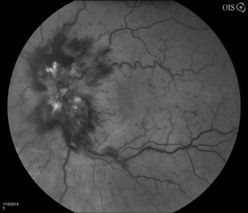 Central Retinal Vein Occlusion with Macular Edema
Patient notices decreased vision in the left eye. VA is 20/60, left eye. Fundus and Fluorescence Angiogram shows CRVO in the left eye with scattered hemorrhages throughout the retina.
