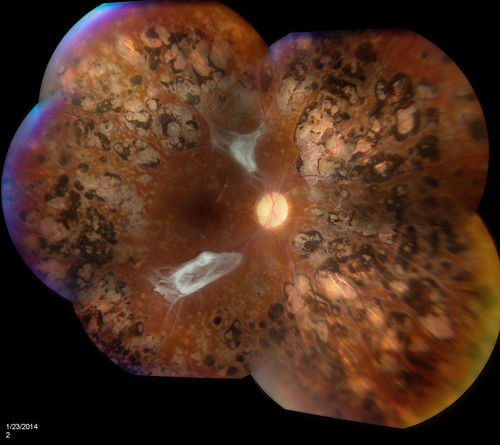 Proliferative Diabetic Retinopathy
Fundus photography shows severe fibrosis and arterial narrowing. Peripheral laser scars in both eyes. VA is 20/40, right eye and 20/50, left eye. 
