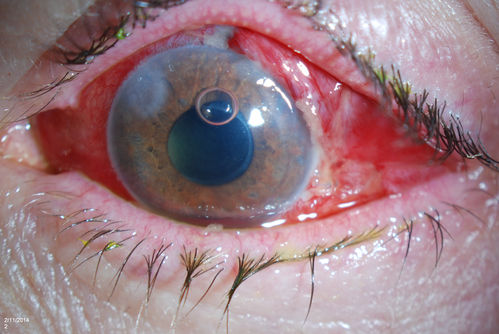 Ahmed Tube Placement with Pericardial Patch
Patient with elevated pressures underwent Ahmed valve placement in the left eye. VA was hand motion. Slit lamp shows a quarter of hyphema in the anterior chamber with Ahmed tube placed temporal at 2-o'clock pressing on the iris. Air bubble is also visible in the anterior chamber in the left eye. 
