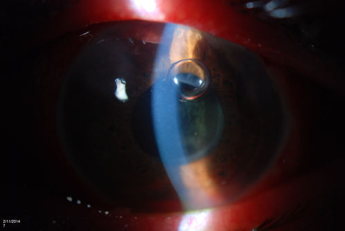 Ahmed Tube Placement with Pericardial Patch
Patient with elevated pressures underwent Ahmed valve placement in the left eye. VA was hand motion. Slit lamp shows a quarter of hyphema in the anterior chamber with Ahmed tube placed temporal at 2-o'clock pressing on the iris. Air bubble is also visible in the anterior chamber in the left eye. 
