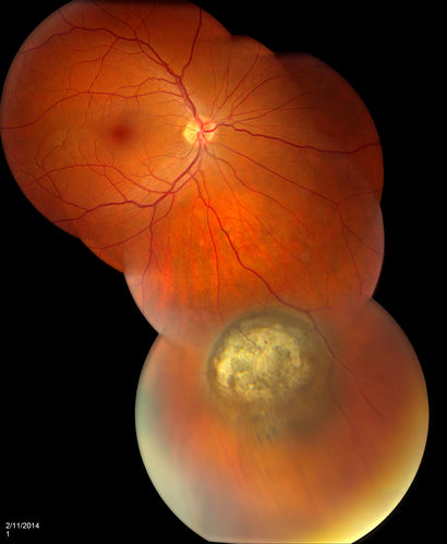 Choroidal Nevus
Patient comes in with pigmented spot in the right eye. VA is 20/25. Fundus photography shows elevated choroidal nevus inferiorily in the right eye. Will be reevaluated in 3-months... 
Schlüsselwörter: february2014