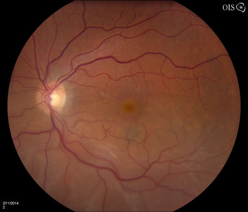 Retinal Detachment with Macula Detached
Patient had sudden loss of vision in the left eye. VA is 20/60 in the left eye. Fundus exam reveals retinal detachment inferiorly from 3-9 o'clock with tear at 3:30. Patient underwent scleral buckle in the left eye.
Keywords: february2014