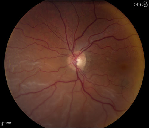 Retinal Detachment with Macula Detached
Patient had sudden loss of vision in the left eye. VA is 20/60 in the left eye. Fundus exam reveals retinal detachment inferiorly from 3-9 o'clock with tear at 3:30. Patient underwent scleral buckle in the left eye.
