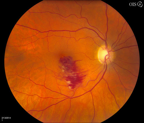 Branch Retinal Vein Occlusion
Patient comes in for eval on retinal hemorrhage in the right eye. VA is 20/30 in the right eye. Fundus photography shows branch retinal vein occlusion inferior of the macula with retinal hemorrhage present. Will reevaluate in 2-months.
Keywords: february2014