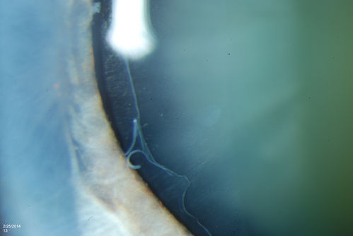 Pseudoexfoliation Material Peeling.
Patient comes in for regular eye exam. Last exam was 8-years ago. Complains of decrease in VA. VA was 20/30, right eye and 20/40, left eye. Slit lamp photography shows pseudoexfoliation peeling of the lens within 360-degrees. Pseudoexfoliation ring is present centrally. IOP was normal. Will revisit in 3-months for follow up.
