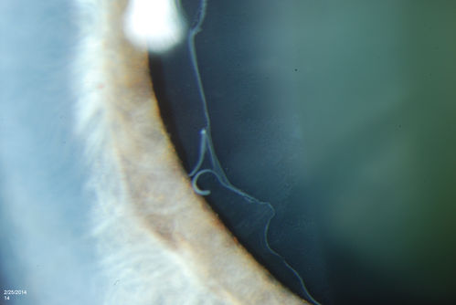 Pseudoexfoliation Material Peeling.
Patient comes in for regular eye exam. Last exam was 8-years ago. Complains of decrease in VA. VA was 20/30, right eye and 20/40, left eye. Slit lamp photography shows pseudoexfoliation peeling of the lens within 360-degrees. Pseudoexfoliation ring is present centrally. IOP was normal. Will revisit in 3-months for follow up.
