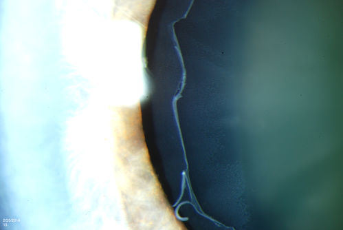 Pseudoexfoliation Material Peeling.
Patient comes in for regular eye exam. Last exam was 8-years ago. Complains of decrease in VA. VA was 20/30, right eye and 20/40, left eye. Slit lamp photography shows pseudoexfoliation peeling of the lens within 360-degrees. Pseudoexfoliation ring is present centrally. IOP was normal. Will revisit in 3-months for follow up.
