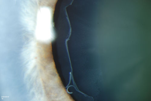 Pseudoexfoliation Material Peeling.
Patient comes in for regular eye exam. Last exam was 8-years ago. Complains of decrease in VA. VA was 20/30, right eye and 20/40, left eye. Slit lamp photography shows pseudoexfoliation peeling of the lens within 360-degrees. Pseudoexfoliation ring is present centrally. IOP was normal. Will revisit in 3-months for follow up.
Keywords: february2014