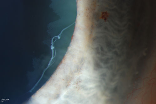 Pseudoexfoliation Material Peeling.
Patient comes in for regular eye exam. Last exam was 8-years ago. Complains of decrease in VA. VA was 20/30, right eye and 20/40, left eye. Slit lamp photography shows pseudoexfoliation peeling of the lens within 360-degrees. Pseudoexfoliation ring is present centrally. IOP was normal. Will revisit in 3-months for follow up.
