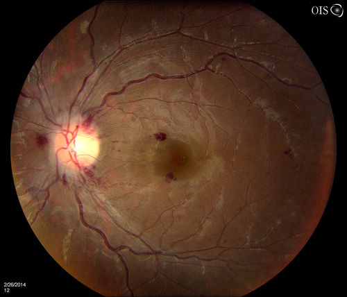 Optic Nerve Edema with Retinal Hemorrhages.
Female patient diagnosed with lupus a year ago, comes in with spot and decreased vision in the right eye. VA is 20/400 in the right eye and 20/40, in the left eye. Fundus photography shows multiple retinal hemorrhages and possible bilateral papilledema. 
