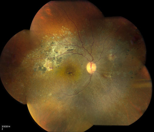 Lupus Retinopathy
Female patient comes in for eval on Lupus Retinopathy. Has poor vision in the right eye. VA is hand motion in the right eye. Fundus photos show fibrosis along the temporal arcades and narrowing of the arteries. No macular edema found.
