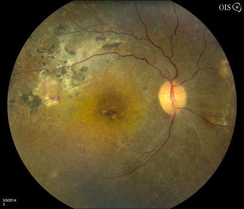 Lupus Retinopathy
Female patient comes in for eval on Lupus Retinopathy. Has poor vision in the right eye. VA is hand motion in the right eye. Fundus photos show fibrosis along the temporal arcades and narrowing of the arteries. No macular edema found.
Keywords: april2014