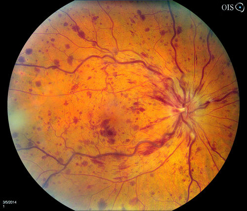 Central Retinal Vein Occlusion
Patient comes in with mild blurred vision in the right eye. Fundus exam shows CRVO with scattered retinal hemorrhages in the right eye.
Keywords: march2014