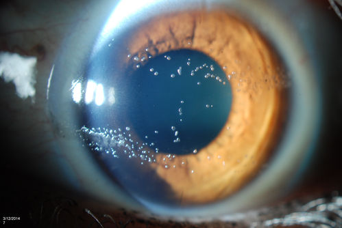 "Jelly Bumps" Soft Contact Lens
Young female patient comes in wearing overnight contact lenses. Complains of irritation in both eyes. Denies sleeping in SCL. Slit lamp exam shows little jelly bumps underneath the contact lens in both eyes. Was issued a new pair and lectured on handling them. 
