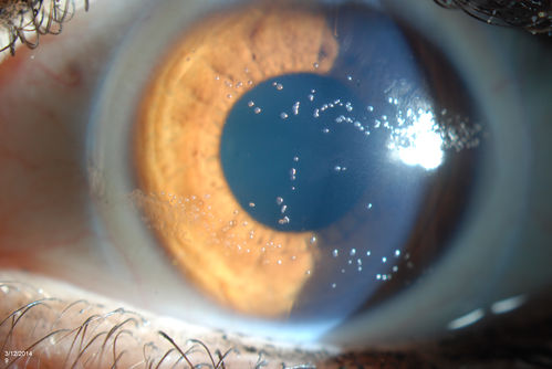 "Jelly Bumps" Soft Contact Lens
Young female patient comes in wearing overnight contact lenses. Complains of irritation in both eyes. Denies sleeping in SCL. Slit lamp exam shows little jelly bumps underneath the contact lens in both eyes. Was issued a new pair and lectured on handling them. 
