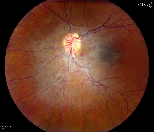 Epiretinal Membrane
Patient with a history of pars planitis comes in with decreased vision in the left eye. VA is 20/30 in the left eye. Fundus photos show a rather large epiretinal membrane covering the optic nerve in the left eye. 
Keywords: march2014