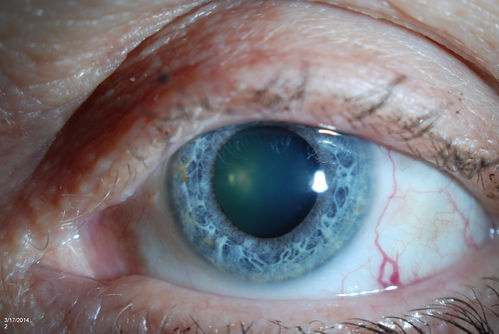 Dilated Conjunctival  Blood Vessels
Patient comes in for routine eye exam. VA 20/20 in both eyes. Fundus exam was normal. Dilated blood vessels are shown temporal inferiorly in the left eye.
