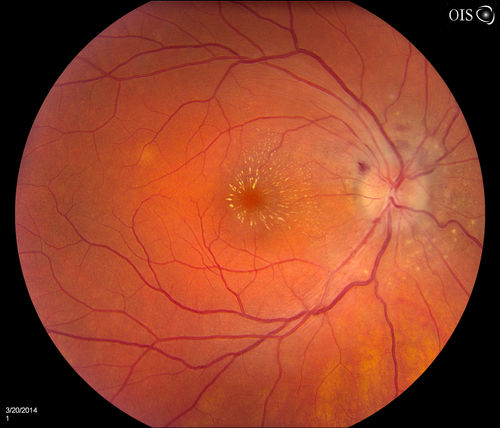 Bilateral Macular Star
Young female patient comes in with blurred vision in both eyes. VA is 20/40 in both eyes. Fundus photos show visible macular star centrally in both eyes. This is a result of Bilateral Neuroretinitis due to cat scratch.
