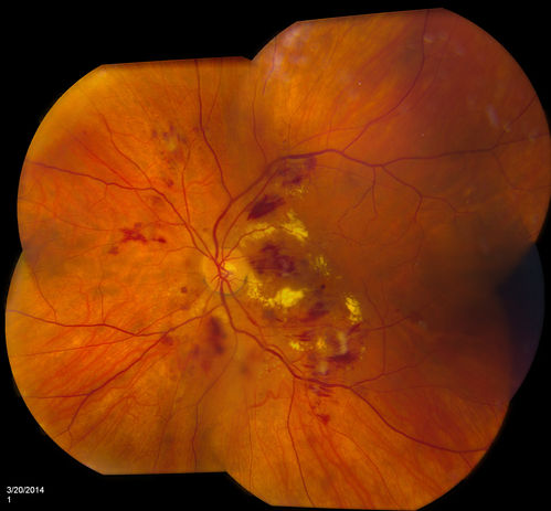 Diabetic Retinopathy
Annual diabetic exam. VA 20/30, right eye and 20/50, left eye. Fundus photos shows hemorrhages with cotton wool spots. Exudates are visible around the macula in the right eye. Scattered hemorrhages in the left eye.
Keywords: march2014