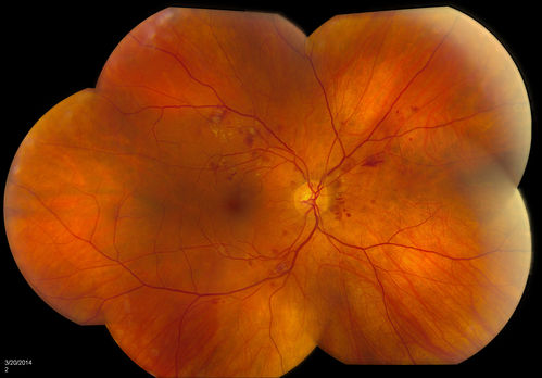 Diabetic Retinopathy
Annual diabetic exam. VA 20/30, right eye and 20/50, left eye. Fundus photos shows hemorrhages with cotton wool spots. Exudates are visible around the macula in the right eye. Scattered hemorrhages in the left eye.
