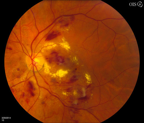 Diabetic Retinopathy
Annual diabetic exam. VA 20/30, right eye and 20/50, left eye. Fundus photos shows hemorrhages with cotton wool spots. Exudates are visible around the macula in the right eye. Scattered hemorrhages in the left eye.

