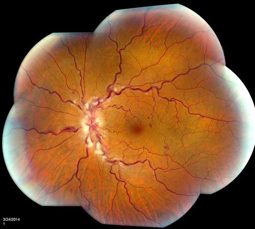 Stasis Retinopathy, Central Retinal Vein Occlusion
Young male who complains of decreased vision in the left eye. VA is 20/20 in the left eye. Fundus photo shows mild central retinal vein occlusion in the left eye. 
