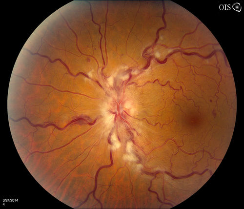 Stasis Retinopathy, Central Retinal Vein Occlusion
Young male who complains of decreased vision in the left eye. VA is 20/20 in the left eye. Fundus photo shows mild central retinal vein occlusion in the left eye. 
Keywords: march2014
