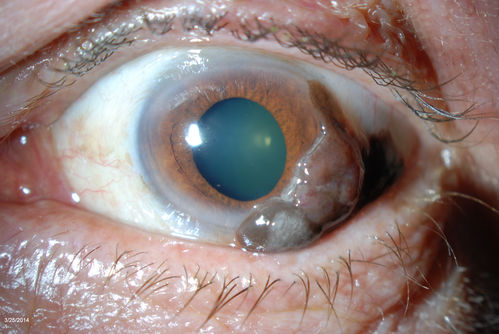 Conjunctival Melanoma
Patient comes in with a conjunctival melanoma in the left eye. Patient states that melanoma grew rather quickly in just a few weeks. Will proceed with biopsy to confirm findings. 
