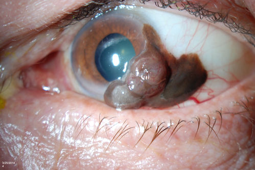 Conjunctival Melanoma
Patient comes in with a conjunctival melanoma in the left eye. Patient states that melanoma grew rather quickly in just a few weeks. Will proceed with biopsy to confirm findings. 
