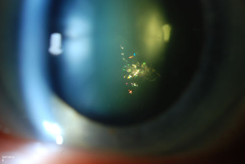 Polychromatic "Christmas Tree" Cataract
Patient comes in for annual eye exam. Eval on cataracts. VA is 20/20, right eye, 20/40, left eye. Slit Lamp exam shows polychromatic christmas tree cataract in the left eye.
