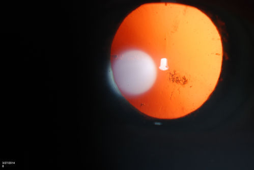 Polychromatic "Christmas Tree" Cataract
Patient comes in for annual eye exam. Eval on cataracts. VA is 20/20, right eye, 20/40, left eye. Slit Lamp exam shows polychromatic christmas tree cataract in the left eye.
